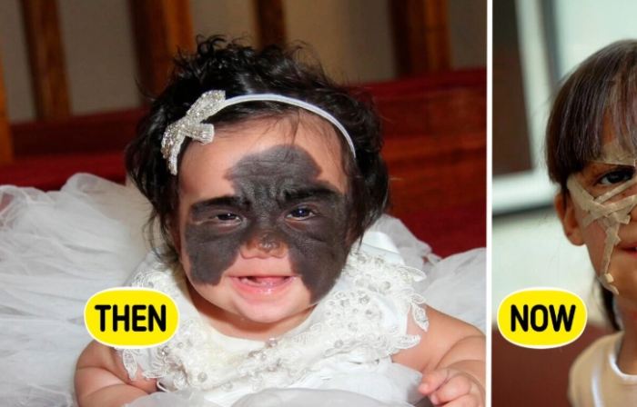 The "Batgirl" with a birthmark was once called a monster; now, she's absolutely stunning.