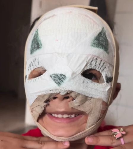 The "Batgirl" with a birthmark was once called a monster; now